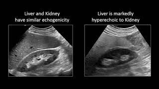 GI Imaging  Hepatic Steatosis and Cirrhosis [upl. by Ebbarta593]