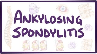 Ankylosing spondylitis  causes symptoms diagnosis treatment pathology [upl. by Volnak]