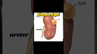 Renal Cyst  Simple Kidney Cyst  Cyst  Fluid Filled  Kidney Ultrasound [upl. by Innattirb]