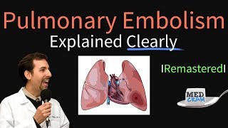 Pulmonary Embolism Remastered  Pathophysiology Symptoms Diagnosis DVT [upl. by Analli]