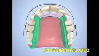 Minor Tooth Movement Appliance  Inman Aligner  Anterior Relapse Correction [upl. by Damarra]