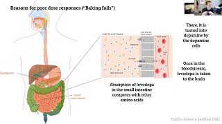 Advanced Therapies Panel Series Duodopa® [upl. by Keith926]