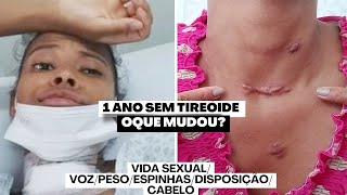 COMO É VIVER SEM TIREOIDE   1 ANO DE TIREOIDECTOMIA  CÂNCER NA TIREOIDE [upl. by Yenot]