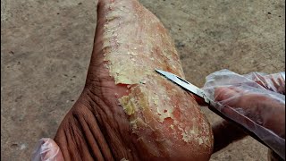 Ultimate Foot Scraping Transformation for an Australian Man [upl. by Gustave]