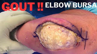 Elbow Olecranon Bursitis Gout Treated in 3 minutes [upl. by Eusadnilem]