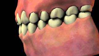 Gingival Hyperplasia [upl. by Kristen]