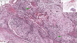 Osteosarcoma  Histopathology [upl. by Letnuahs]