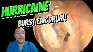 HURRICAINE BURST EAR DRUM 351 ear earwax earwaxremoval satisfying foryou fyp foryourpage [upl. by Anatlus]