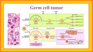 germ cell tumor [upl. by Nickerson]