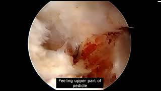 Biportal Endoscopic UBE Lumbar Interbody Fusion EndoTLIF UBE TLIF for Lytic Spondylolisthesis [upl. by Eittod]