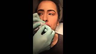 Lip Filler Volbella amp Juvederm with Nurse Cynthia [upl. by Anauqahs]