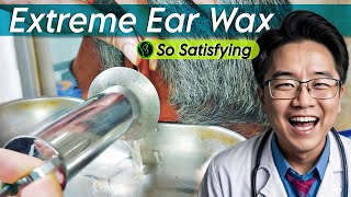 Extreme Ear Wax Removal earwaxremoval earwaxremoving earwax [upl. by Atnod130]