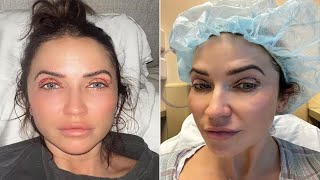 Kaitlyn Bristowe Shares Raw PostOp Photos from Eyelid Surgery Everyone Wants to Look Like This [upl. by Mellicent]