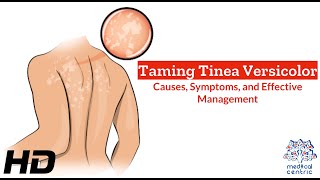 Tinea Versicolor Unveiled Causes Symptoms and Solutions [upl. by Prosper]