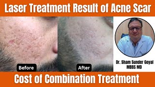 Laser Treatment Result of Acne Scar Treatment  Cost of Combination Treatment [upl. by Cedric]