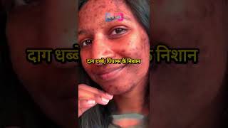 GET RID OF ACNE FAST  Clear Skin in Days Proven Methods [upl. by Alimrahs]