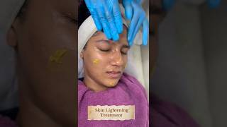 Yellow Peel Skin Lightening peelSkin Smile Clinic Bhopal ☎️ 9691918200skincare bhopal [upl. by Fulks654]