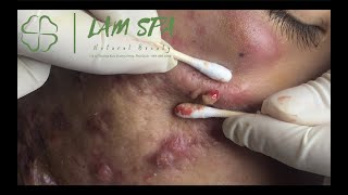 Treatment of acne pustules severe inflammation  MrL Part2  Điều trị mụn mủ viêm nặng  LAMSPA [upl. by Ahtelra]