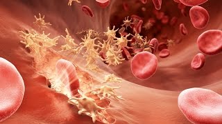 Understanding Hemophilia [upl. by Balas329]