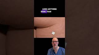 The Importance of Full Body Mole Checks A Hidden Melanoma Case [upl. by Itsim]