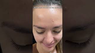 Which is best for you Hydrocolloid vs Magnesium Acne Patches acne freegopatch skincare [upl. by Smitt]