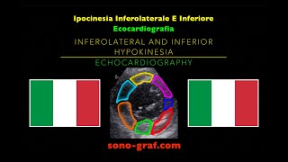 Ecocardiografia  Ipocinesia Inferolaterale E Inferiore [upl. by Etsirk]