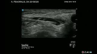 Nervus femoralis block case I Ultrasound Practical demo technique Regional Anesthesia Femur fracture [upl. by Gnilsia]