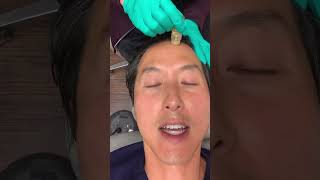 Watch Dr Youn Get a Gold Filltox Facial botox microneedling prp filler facial aquagold [upl. by Weinreb863]