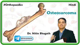 Osteosarcoma Hindi  Orthopedic Lectures [upl. by Mendy229]