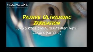 passive ultrasonic irrigation with irrisafe satelec in endodontic treatment [upl. by Nachison]