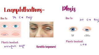 Lagophthalmos and PtosisWhat is the difference between them Ophthalmology [upl. by Hemetaf]