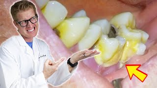 Patients Tooth FALLS OUT During Deep Cleaning TONS OF PLAQUE TARTAR amp GROSS Bacteria Removed [upl. by Cathrine974]