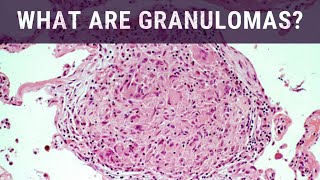 What are Granulomas  Pathology mini tutorial [upl. by Sutniuq33]