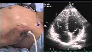 Intro to Echo Apical 4 Chamber Viewmov [upl. by Akenat]