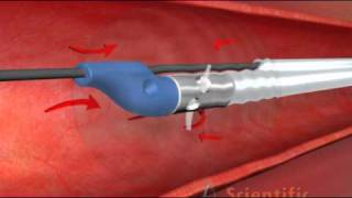 Thrombectomy Catheter  3D Medical Animation [upl. by Ecinehs]