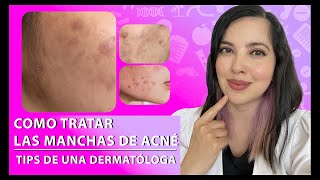 ¿Tienes MANCHAS POR ACNÉ Tips de una Dermatóloga 👩🏻‍⚕️👌🏻 [upl. by Kannav60]