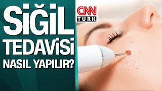 Siğil tedavisi nasıl yapılır [upl. by Noe]