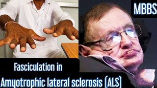 Fasciculation in Amyotrophic lateral sclerosis ALS mbbs medicine neet usmle aiims next [upl. by Jeniece848]