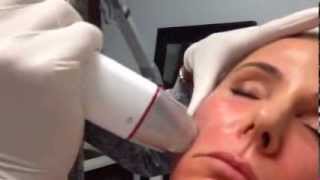 Infini demonstration by Dr Steven Weiner RF Microneedling Skin Tightening [upl. by Millan]