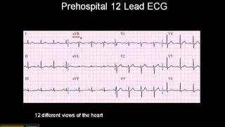 1215 Lead ECG The 12 Leads [upl. by Christoffer]