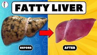 Strictly Avoid these 5 Foods if you have Fatty Liver  Fatty liver treatment  liver disease [upl. by Keel]