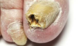 BEST TOENAIL FUNGUS REMEDY Clear Your Nails Fast amp Naturally at Home Best Toenail Fungus Treatment [upl. by Fi]