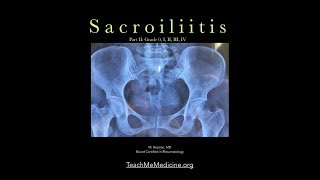 Sacroiliitis A common cause of back pain Part II [upl. by Akiemehs]