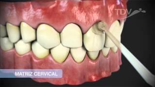 MATRIZ CERVICAL TDV  Restauraciones de Clase V [upl. by Ciri309]