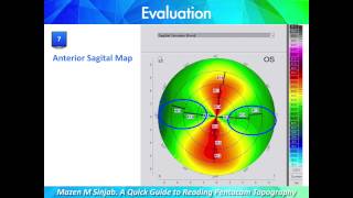 A Quick Guide to Reading Corneal Topography Part 1 [upl. by Nylirem]