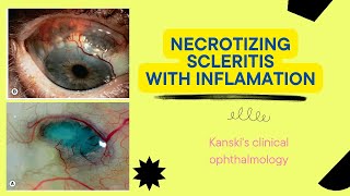 Necrotizing scleritisKanskis clinical ophthalmology sclera ophthalmology kanski medical [upl. by Eolande]