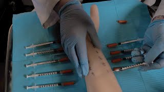 ASMR Hospital Allergy Testing  Intradermal Test Skin Exam [upl. by Atoiganap]