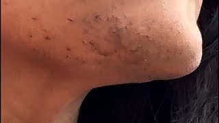 INGROWN HAIR REMOVAL 75 [upl. by Iadam]