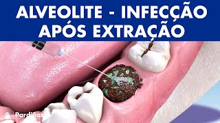 ALVEOLITE  Infecção após extração dente causas e tratamento © [upl. by Haskins365]