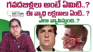 గవదబిళ్లలు అంటే ఏమిటి  Acute Parotitis or Mumps in Telugu  Dr Harika ENT Care Hospital [upl. by Benil]